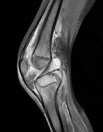 Septic arthritis Radiology Reference Article Radiopaedia.org