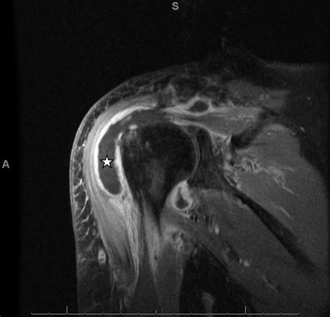 Septic arthritis of the glenohumeral joint. A report of 11