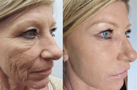 Skin sermorelin before and after photo; Skin sermor