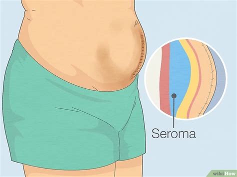 Seroma after c-section - Women