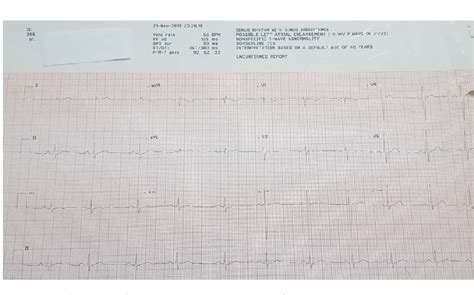 Severe Hypokalemia ECG Changes Mimicking Those of Acute …