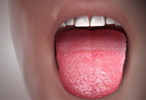 Severe dry mouth at night General center SteadyHealth.com