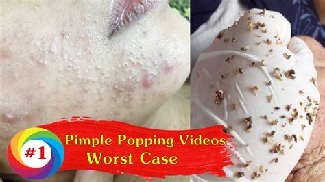 Severe infected blackhead removal videos 2023. Bioré Deep Cleansing Pore Strips. Read more. Ahead, find a few skincare picks that dermatologists recommend as their favorite blackhead treatments. Ranging from face washes to extraction tools ... 