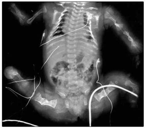 Severe osteogenesis imperfecta Type-III and its challenging …