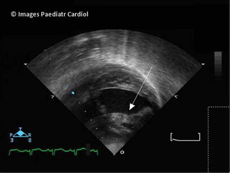 Severe reversible dilated cardiomyopathy and ... - Europe PMC