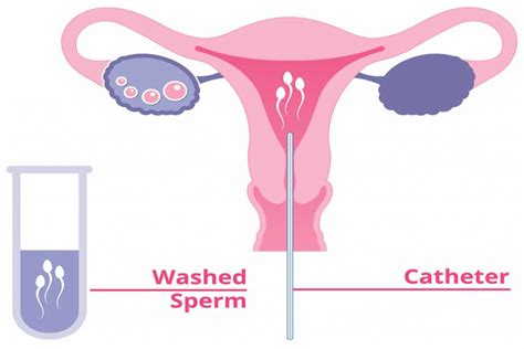 Sex before IUI????? - Fertility Treatments - What to Expect