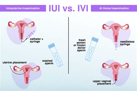 th?q=Sex before iui