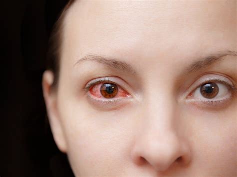 Sexually Transmitted Diseases: Your eyes could be dropping …