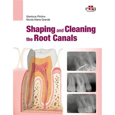 Shaping and Cleaning for Successful Root Canal Treatment