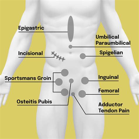 Sharp pain after inguinal hernia surgery. .  <a href=https://apply.emsacademy.kg/mo...