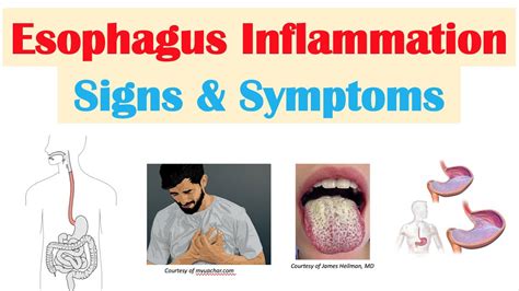 Sharp pain in top of esophagus : r/GERD - reddit.com