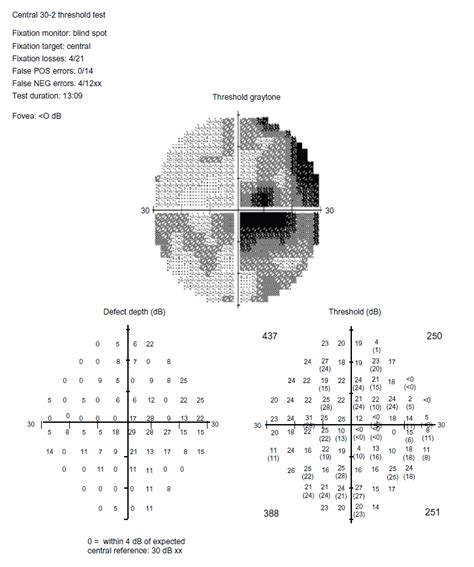 Sharpen Your Visual Field Interpretation Skills