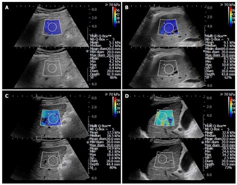 Shear wave elastography in assessment of liver stiffness