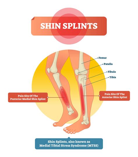 Shin splints va rating. The word "shin splints" means pain along the inner side of the shin bone (tibia) — the largest bone in the front of the lower leg. Medically it is termed medial tibial stress syndrome. It is an inflammation of the muscle, tendons, and bone tissue around the tibia. Generally, it occurs between the lower leg and ankle. 