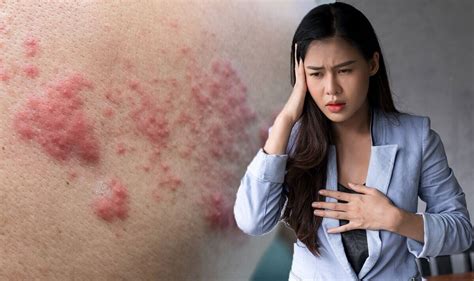 Shingles: Vertigo could be a sign of a Ramsay Hunt …