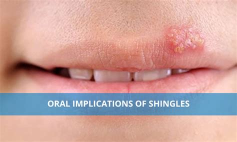 Shingles in Your Mouth: Treatment and More - Verywell Health