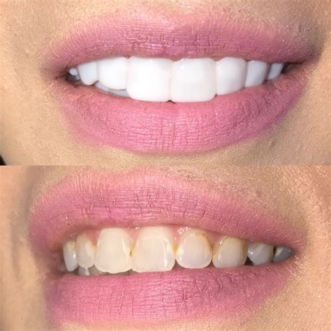 Shiny smile veneers reviews. 12 Dec 2021 ... In today's video I am sharing a little hack/tip that was recommended to me. I put denture cream on my Shiny Smile Veneers and this is what ... 