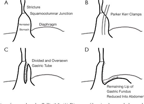 Short Esophagus SpringerLink