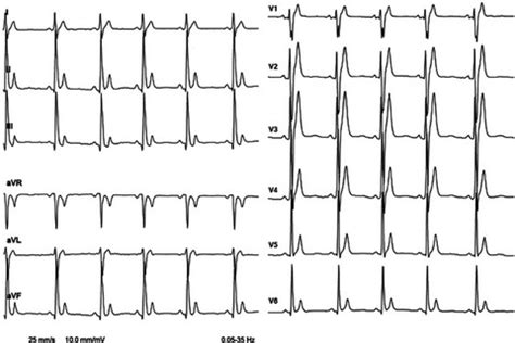 Short QT syndrome: The current evidences of diagnosis and ... - PubMed