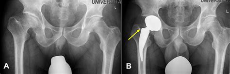 Short stem for total hip arthroplasty ORR - Dove Medical Press