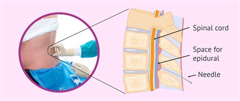 Shot in spine during labor