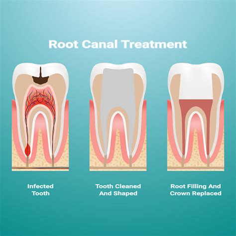 Should you get a root canal