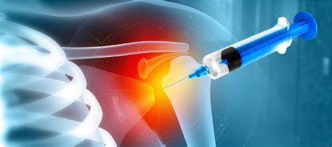 Shoulder Arthroscopy Recovery Time What to Expect and How Long It