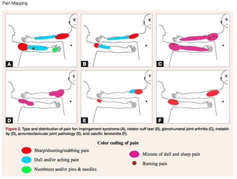 Shoulder Pain Referral Patterns are Reported in This Study LASTechnique