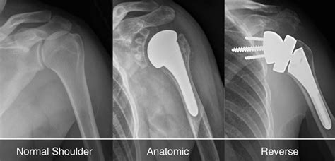 Shoulder Replacement Arthroplasty for Shoulder Arthritis