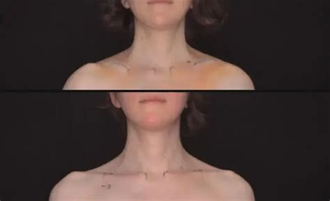 Shoulder width reduction surgery price.  Shoulder reduction surgery, also known as...