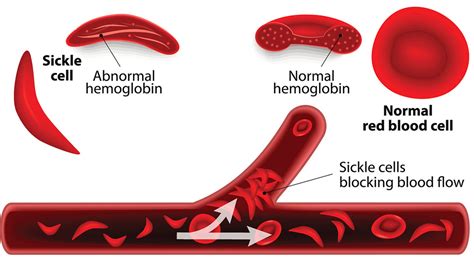 Sickle Cell Anemia Diagram Quizlet