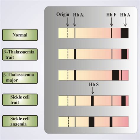 Sickle Cell test Flashcards Quizlet