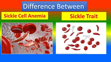 Sickle cell trait vs sickle cell anemia differences