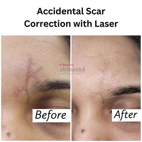 Side Effects of Lasers Skinacea.com