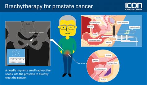 Side effects HDR brachytherapy? - Prostate cancer - Inspire