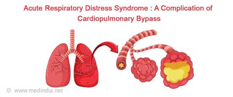 Side effects of cardiopulmonary bypass: what is the reality?