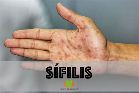 Sifilis...