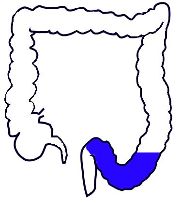 Sigmoid colon - Wikipedia