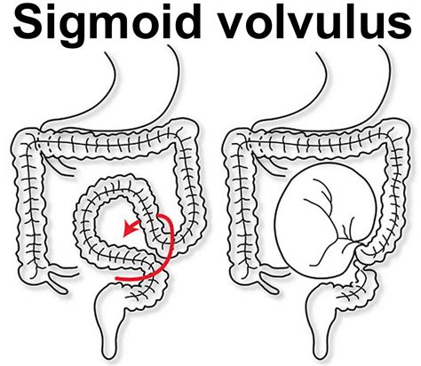 ACCORDING TO statistics, volvulus of the sigmoid is respon