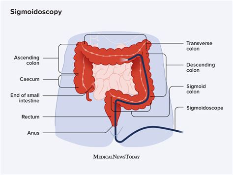 Sigmoidoscopy What is it uses and what to expect