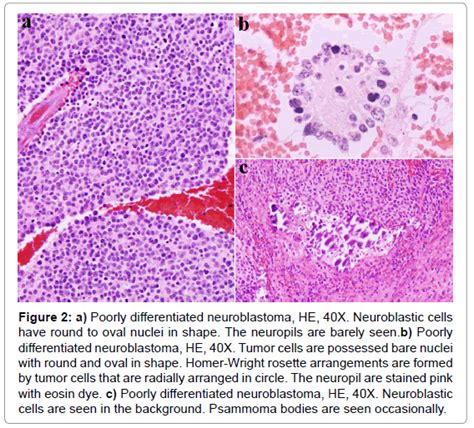 Significance of cytological findings of neuroblastomas …