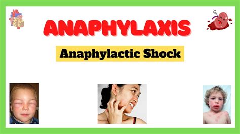 Signs and symptoms of anaphylaxis - YouTube