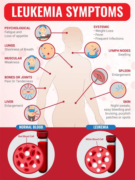 Signs of Leukemia in Adults - Healthline