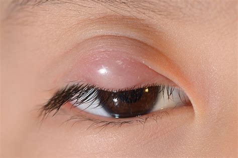 Signs of Stye and Treatments to Get Rid of It New Health Advisor