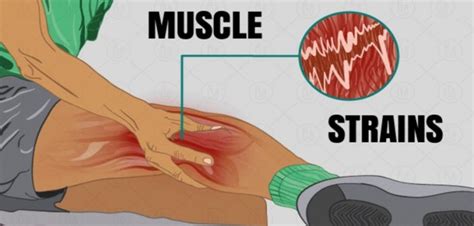 Estratégias Eficazes para Prevenir e Recuperar de Distensões Musculares