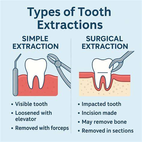 Simple extraction vs surgical extraction wisdom teeth.  A surgical extraction is n...