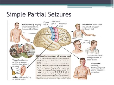 Th?Q=Simple Partial Seizure