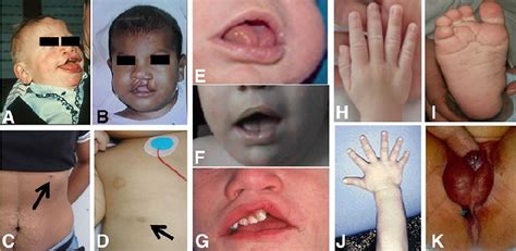 Simpson-Golabi-Behmel syndrome - Genetic and Rare …