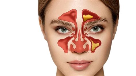 Sinüzit  TATLIPINAR.