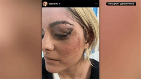 Singer Bebe Rexha suffers black eye after hit by cellphone at NYC concert